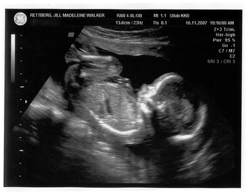 ultrasound image of baby